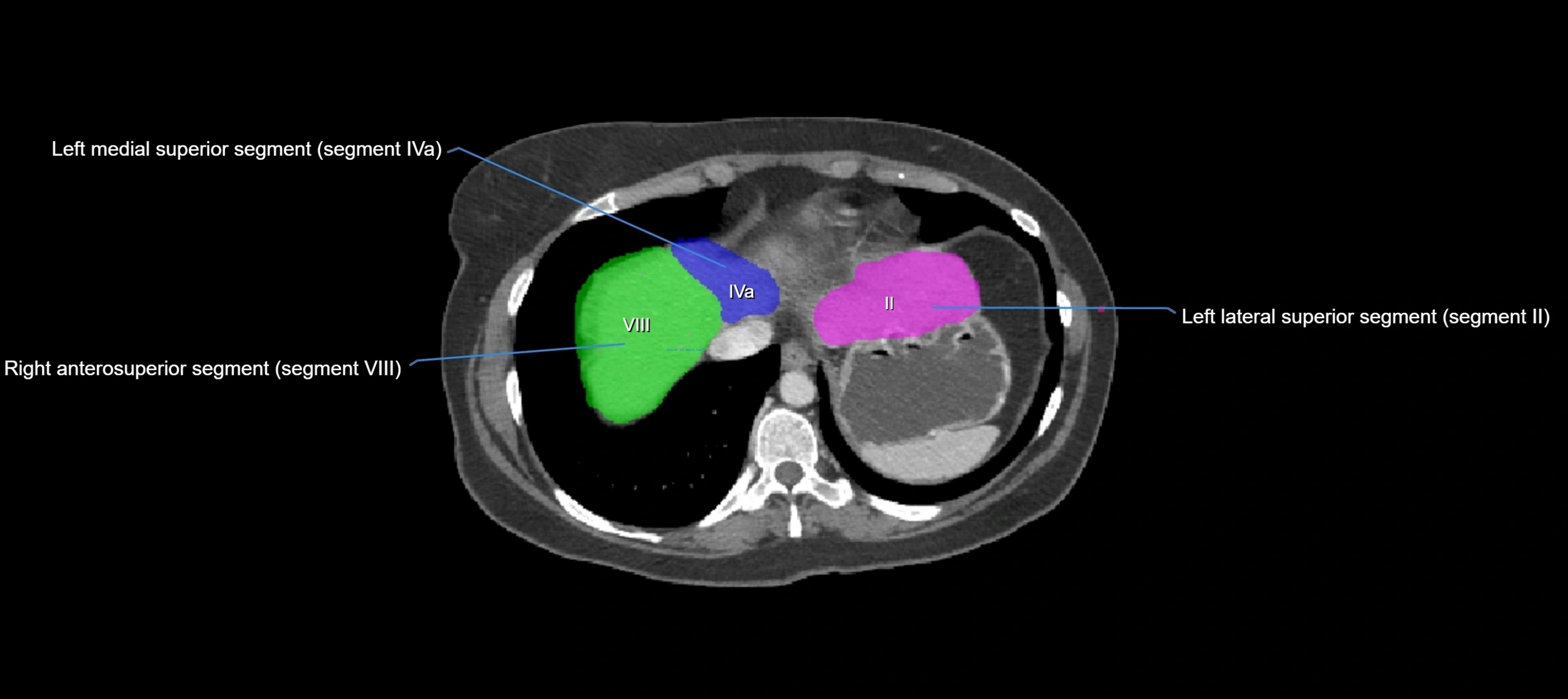 CT liver segments axial cross sectional anatomy labelled image-00071.webp